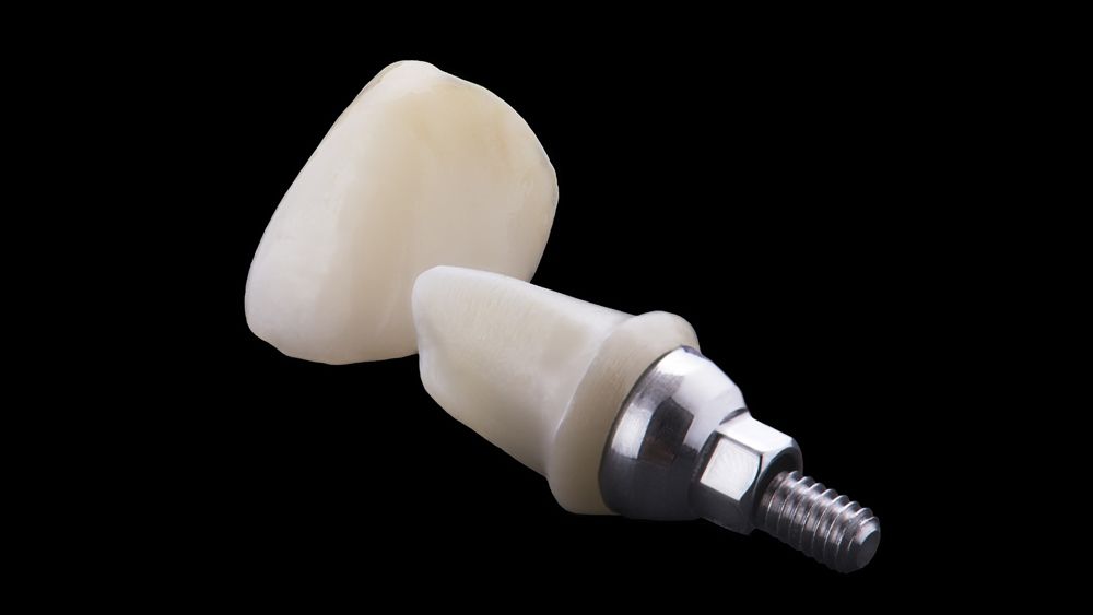 Одиночная коронка и абатмент из циркония